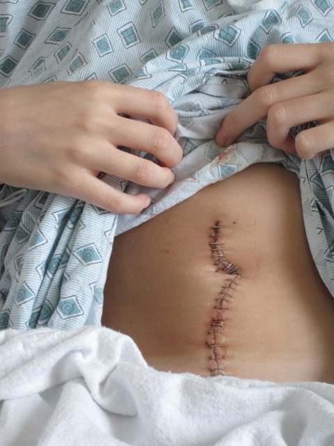 crohn's surgery scar